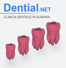 Corone dentali e faccette estetiche con i dentisti in Albania
