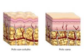 TRATTAMENTI ANTI-CELLULITE, VISITA GRATUITA