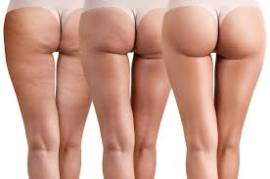 TRATTAMENTI ANTI-CELLULITE, VISITA GRATUITA