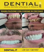 Quanto costa andare dal dentista in Albania?