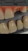 Riparazione protesi dentale immediata Domicilio Festivi su appuntamentoBologna